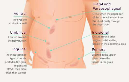types_of_hernias_desktop
