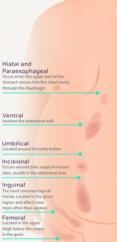 types_of_hernias_mobile